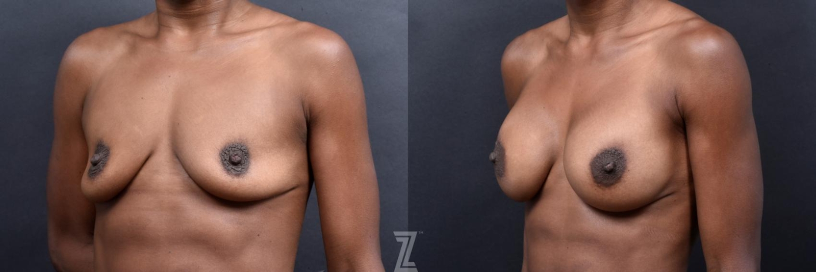 Austin oblique view of before and after view of 33 year old athletic mom of two children breast augmentation - The Piazza Center