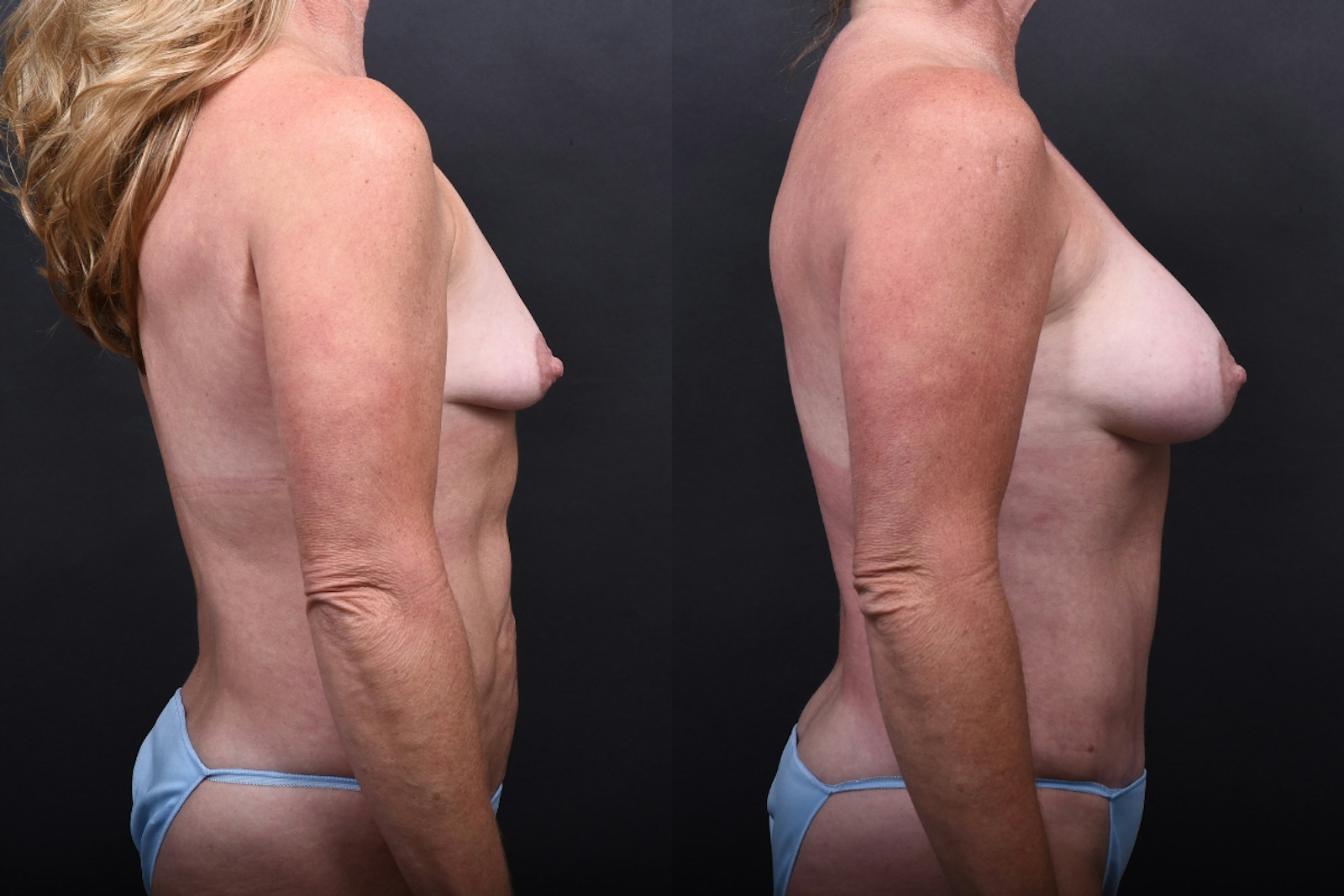 Austin Breast Augmentation Before & After Gallery - Patient 158035 - Image 3 - The Piazza Center