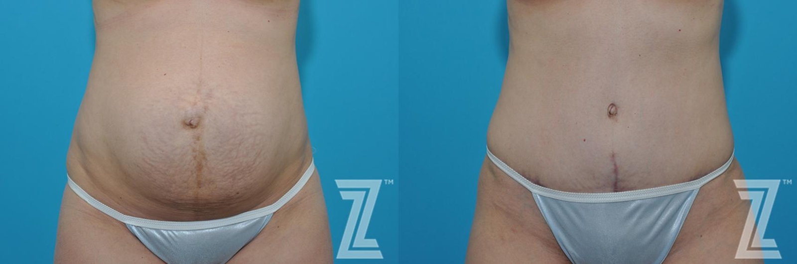 Austin Frontal abdominal view before & after 3 month post op 39 year old woman mommy make over - The Piazza Center, Austin TX - The Piazza Center
