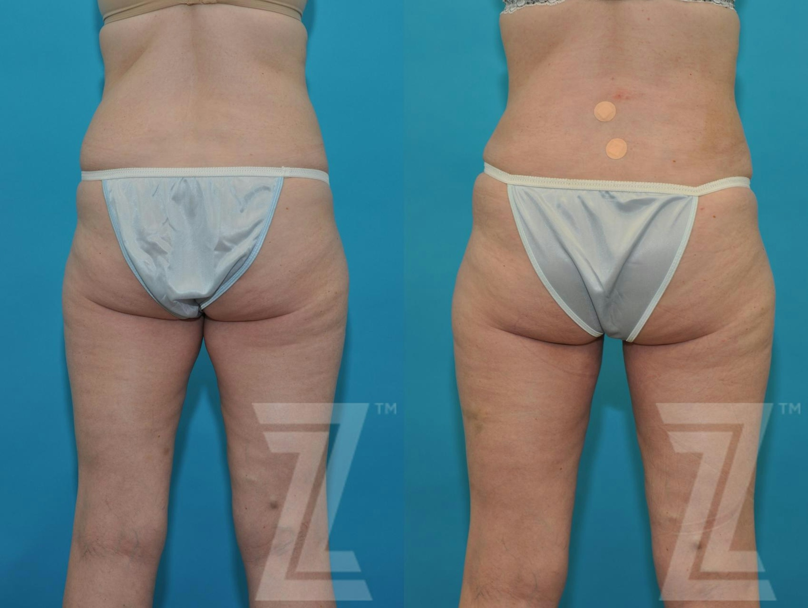 Austin Tummy Tuck Before & After Gallery - Patient 132886874 - Image 2 - The Piazza Center