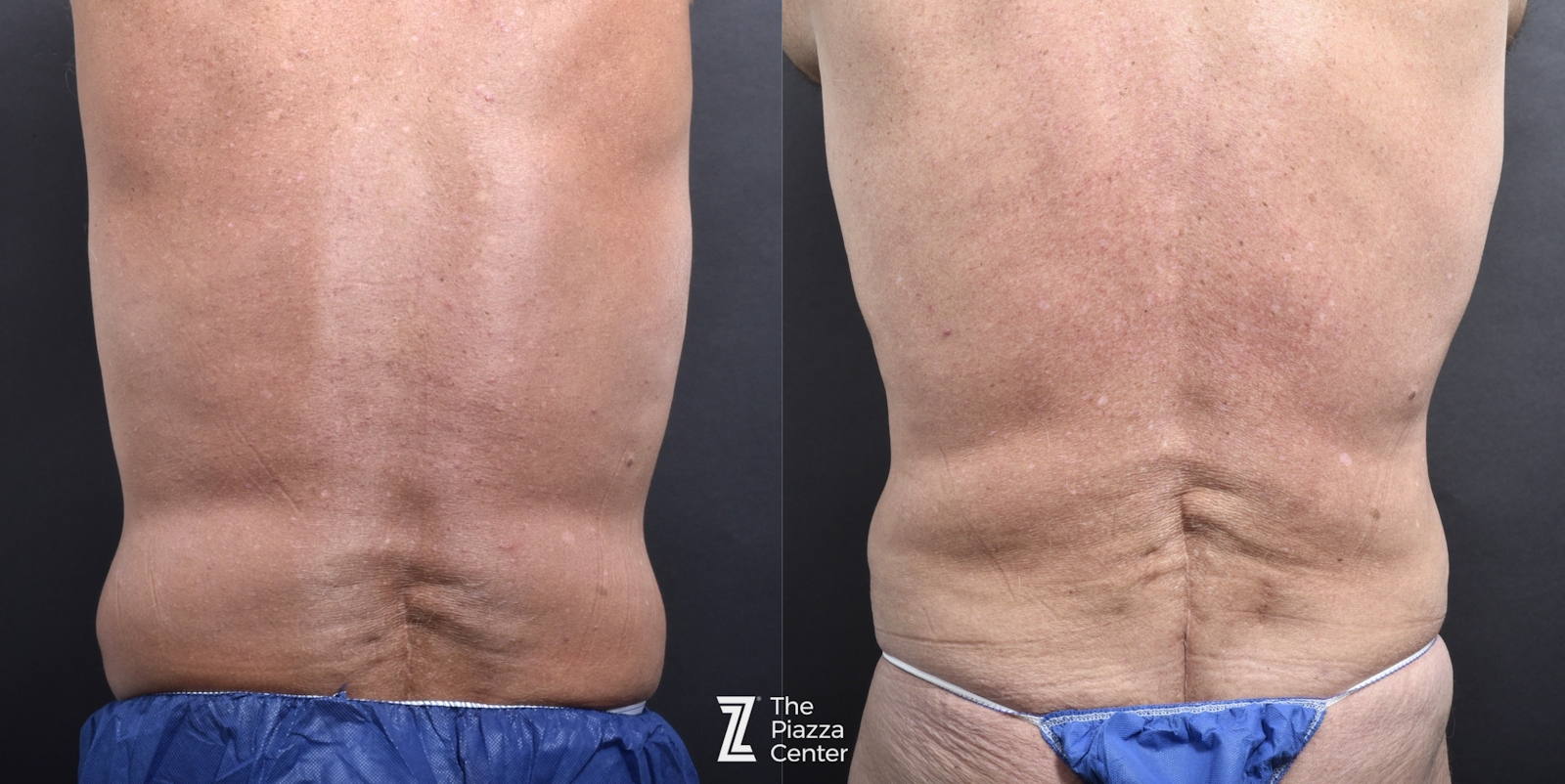 Austin Male Body Contouring Before & After Gallery - Patient 106395 - Image 4 - The Piazza Center
