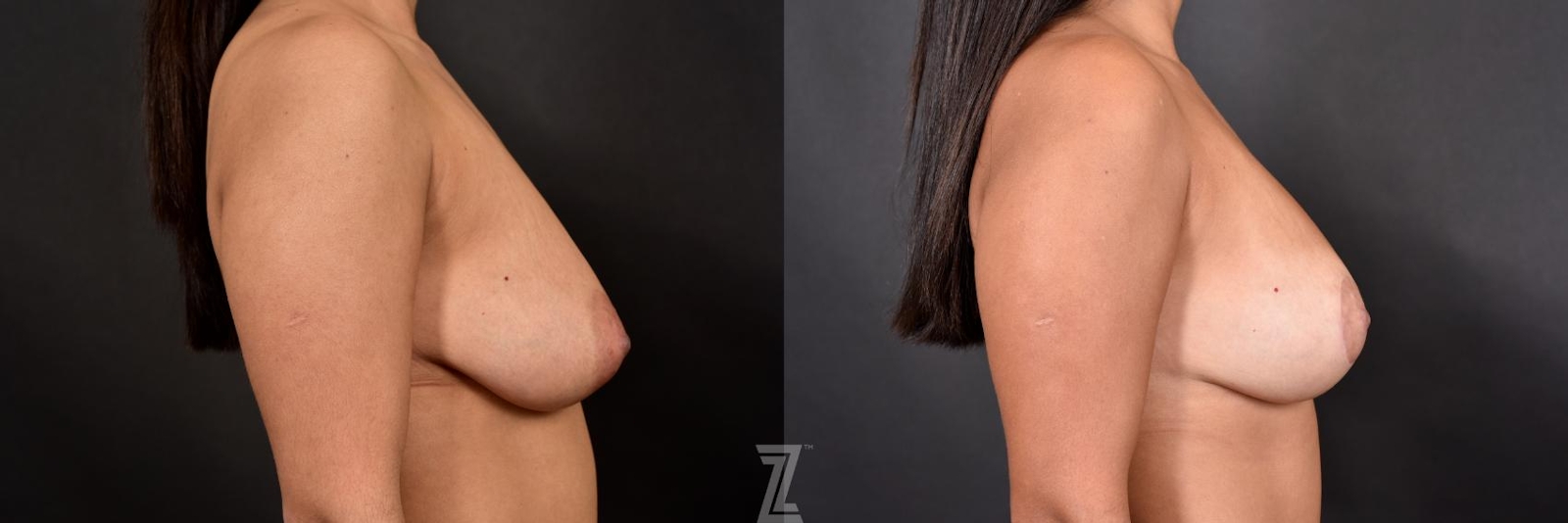 Austin Breast Lift Before & After Gallery - Patient 132791072 - Image 5 - The Piazza Center