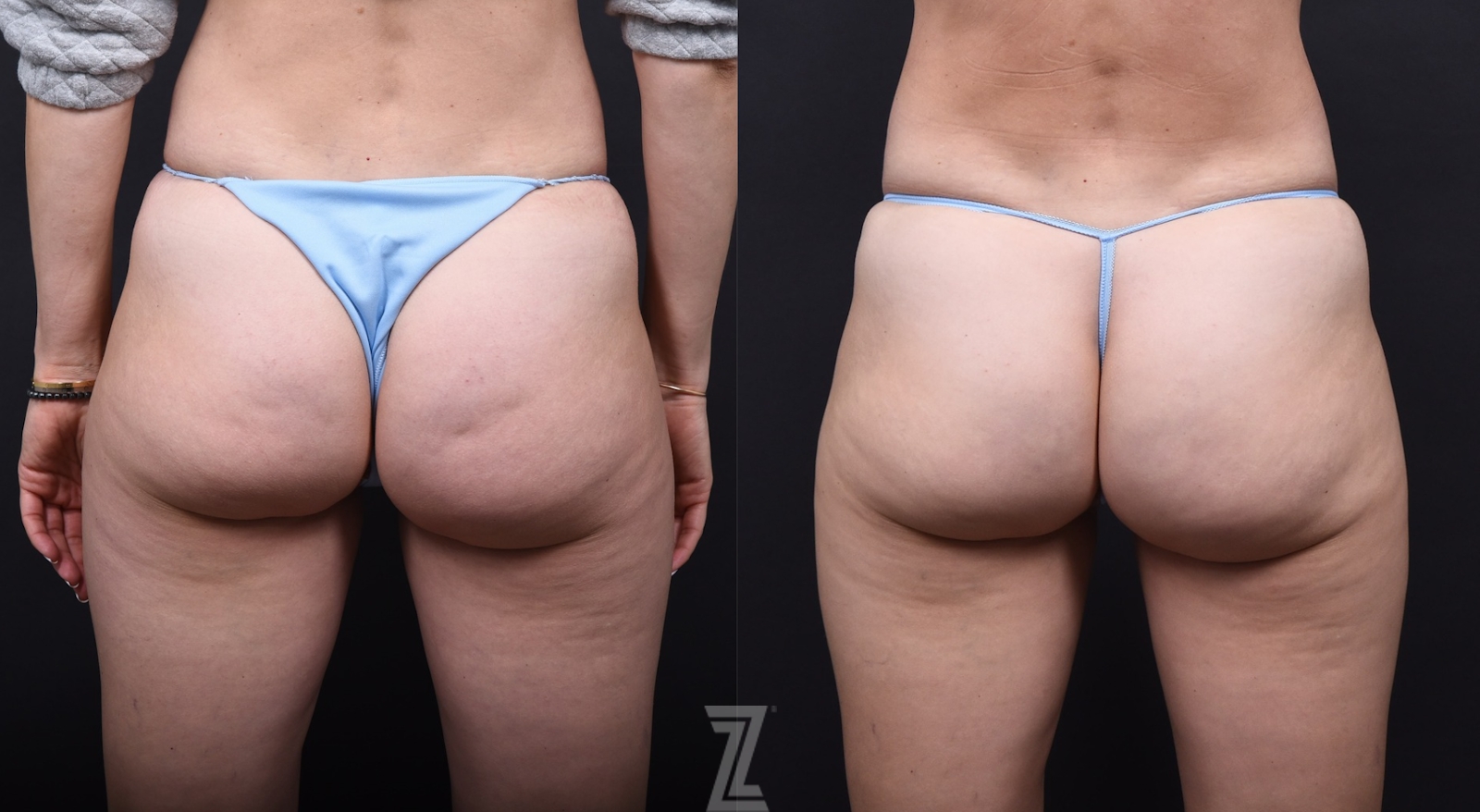 Austin Avéli Before & After Gallery - Patient 259796 - Image 1 - The Piazza Center