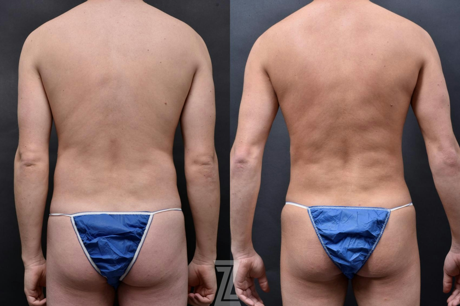 Austin Male Body Contouring Before & After Gallery - Patient 273342 - Image 2 - The Piazza Center