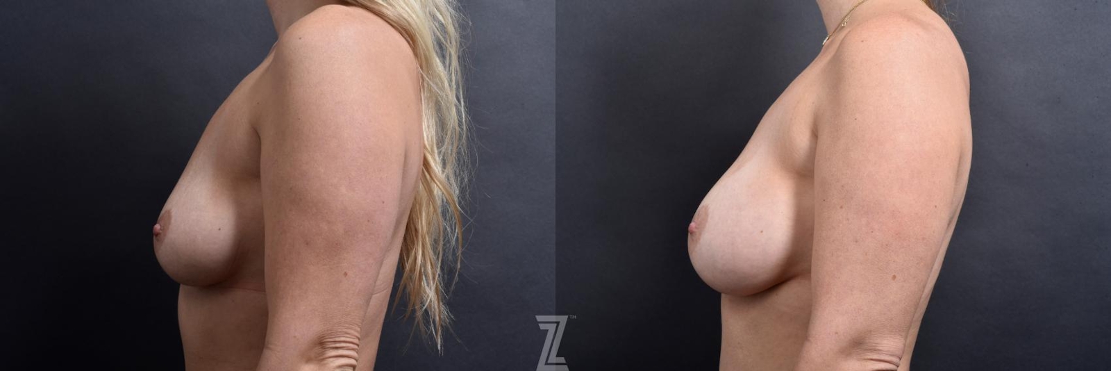 Austin Side view of 6 month post op before and after image of 39 year old woman with Silicone Implants with Cohesive Silicone Gel - The Piazza Center