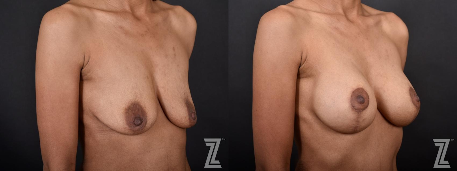 Austin 34-Year-Old Mom of Three Children Mommy Makeover Before & After by Dr. Rocco Piazza in Austin, Texas - Oblique View of Breasts - The Piazza Center