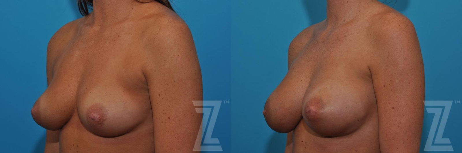 Austin Correction of Breast Asymmetry Before & After Gallery - Patient 132886779 - Image 2 - The Piazza Center