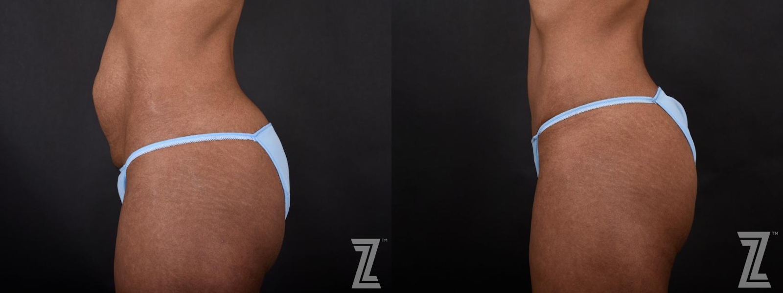Austin 34-Year-Old Mom with Three Children Mommy Makeover Before & After by Dr. Rocco Piazza in Austin, Texas - Lateral View of Abdomen - The Piazza Center