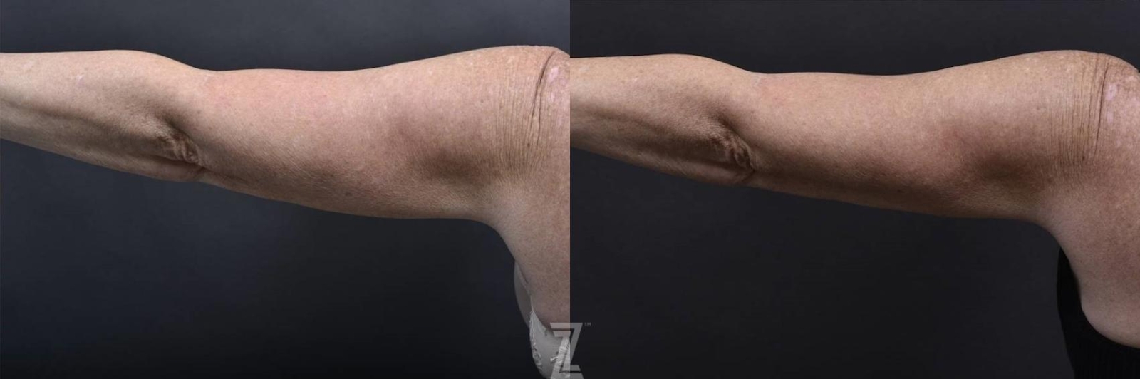 Austin Profound® RF Microneedling Before & After Gallery - Patient 132963569 - Image 2 - The Piazza Center