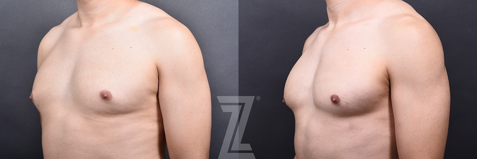 Austin Gynecomastia/Male Breast Reduction Before & After Gallery - Patient 105962 - Image 4 - The Piazza Center