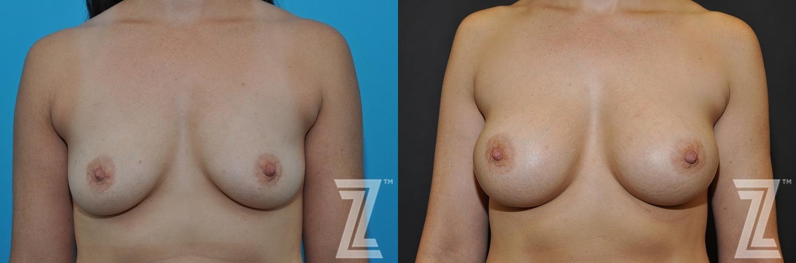 Austin Frontal View before & after images of 33 year old woman with breast augmentation - The Piazza Center - The Piazza Center