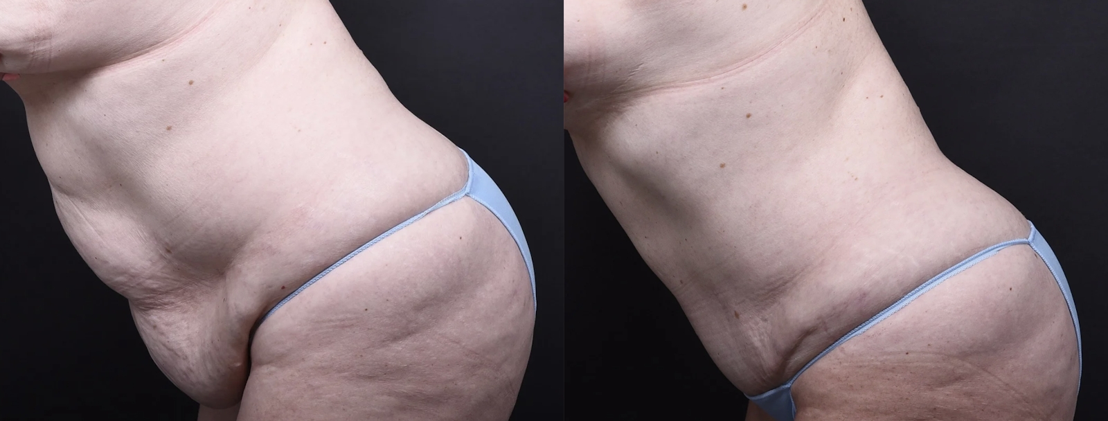 Austin Tummy Tuck Before & After Gallery - Patient 101511 - Image 3 - The Piazza Center