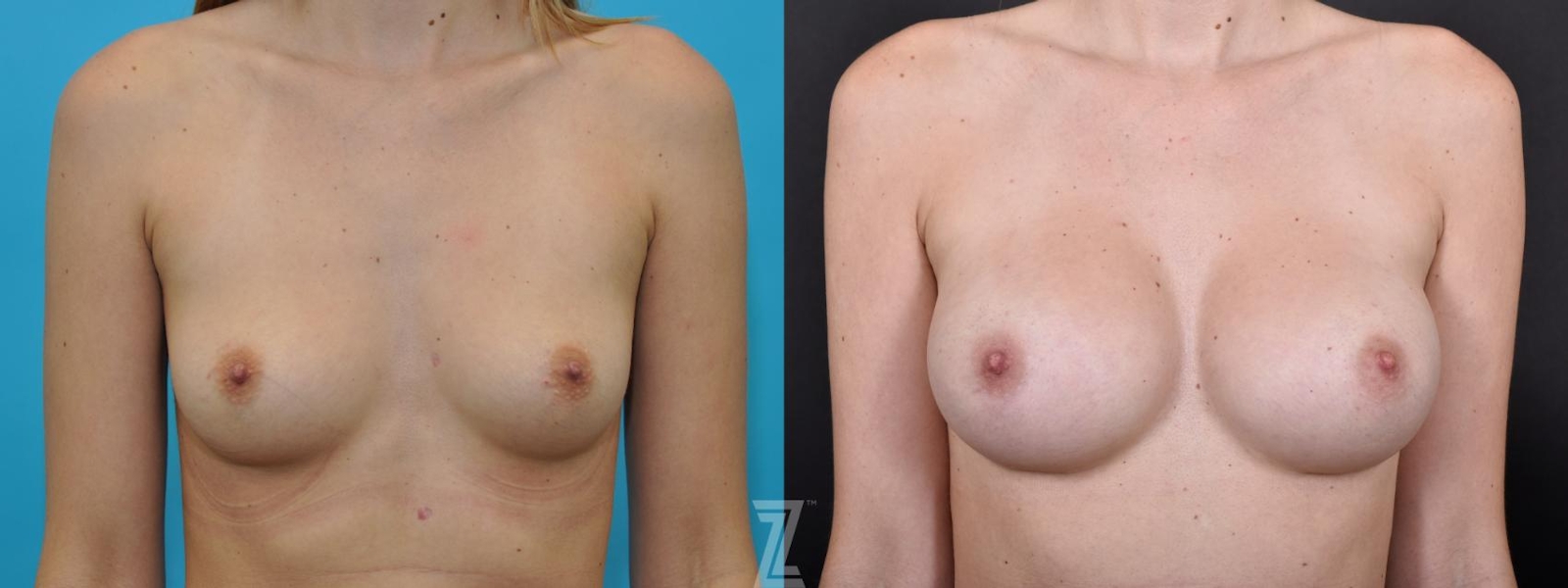 Austin Bilateral before and after image of 25 year old woman with Silicone Implants with Highly Cohesive Gel (Gummy Bear Implants) - The Piazza Center