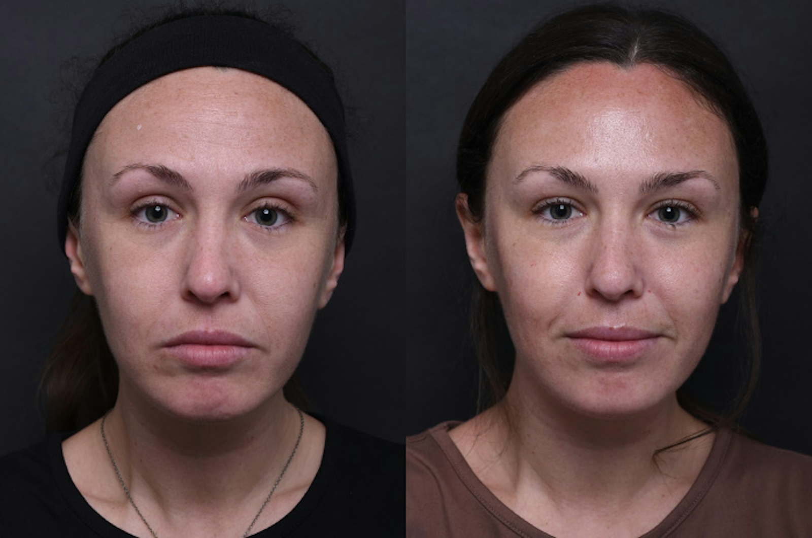 Austin Wrinkle Relaxers Before & After Gallery - Patient 325403 - Image 1 - The Piazza Center