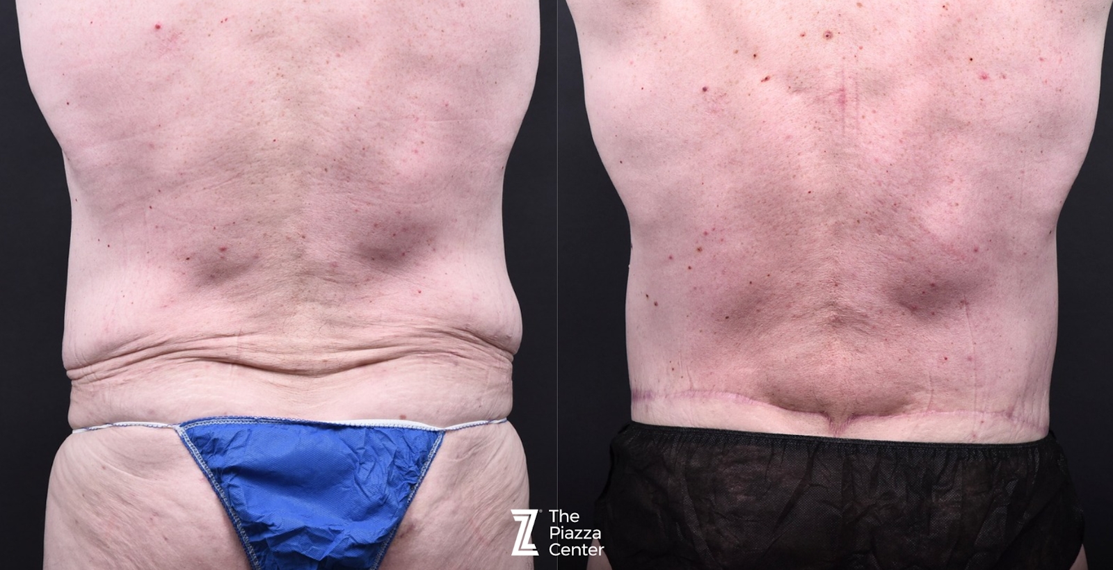 Austin Tummy Tuck Before & After Gallery - Patient 220707 - Image 3 - The Piazza Center