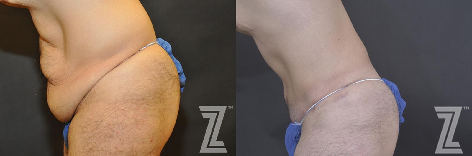 Austin Tummy Tuck Before & After Gallery - Patient 132886870 - Image 3 - The Piazza Center