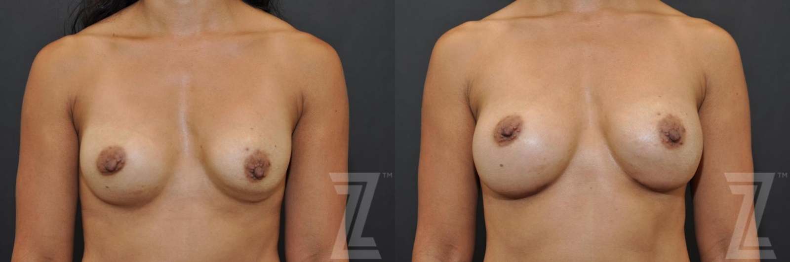 Austin Breast Augmentation Revision Before & After Gallery - Patient 132886551 - Image 1 - The Piazza Center
