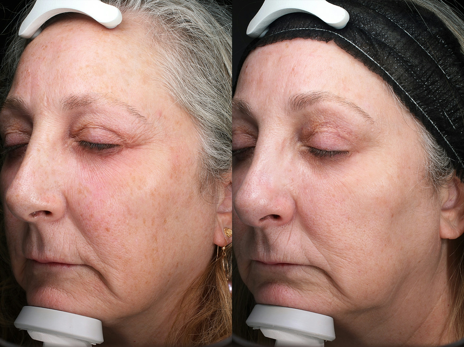 Austin Moxi Before & After Gallery - Patient 200681 - Image 3 - The Piazza Center
