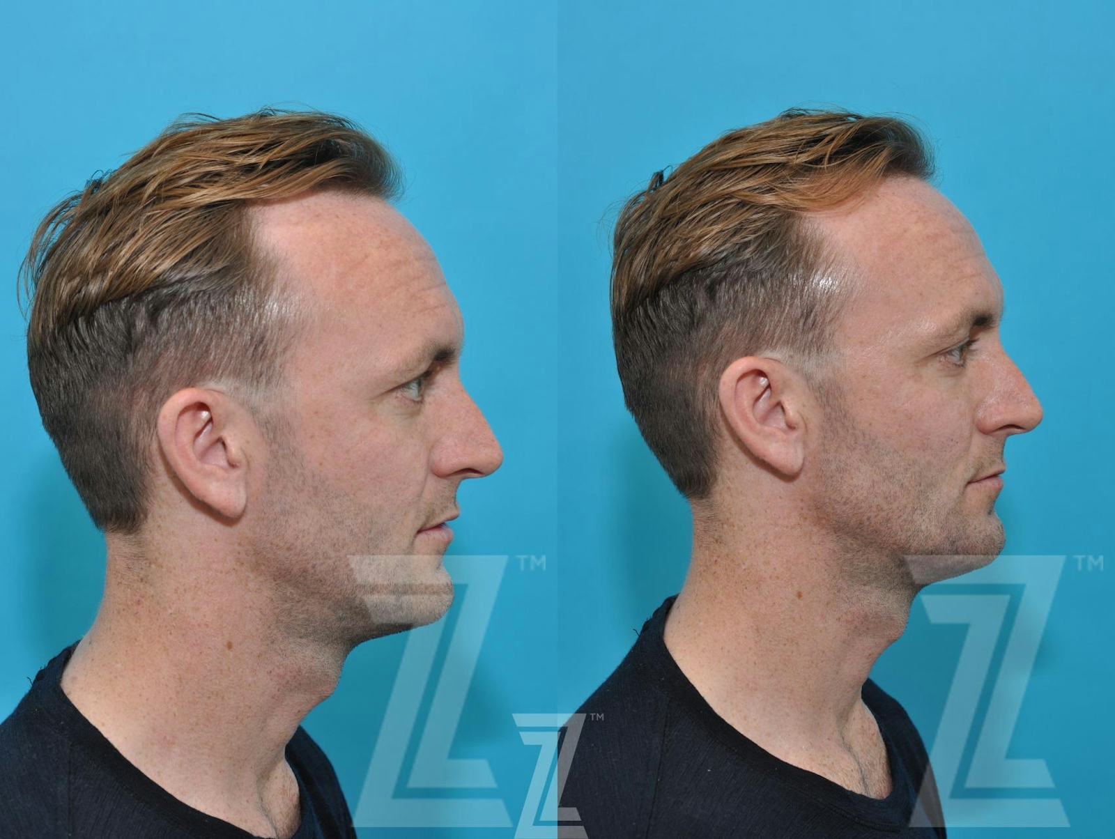 Austin Injectable Fillers Before & After Gallery - Patient 132963102 - Image 3 - The Piazza Center