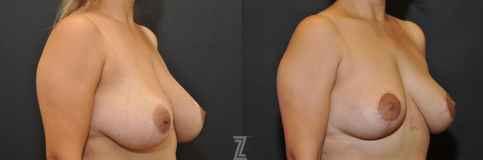 Austin Breast Lift Before & After Gallery - Patient 132791061 - Image 4 - The Piazza Center