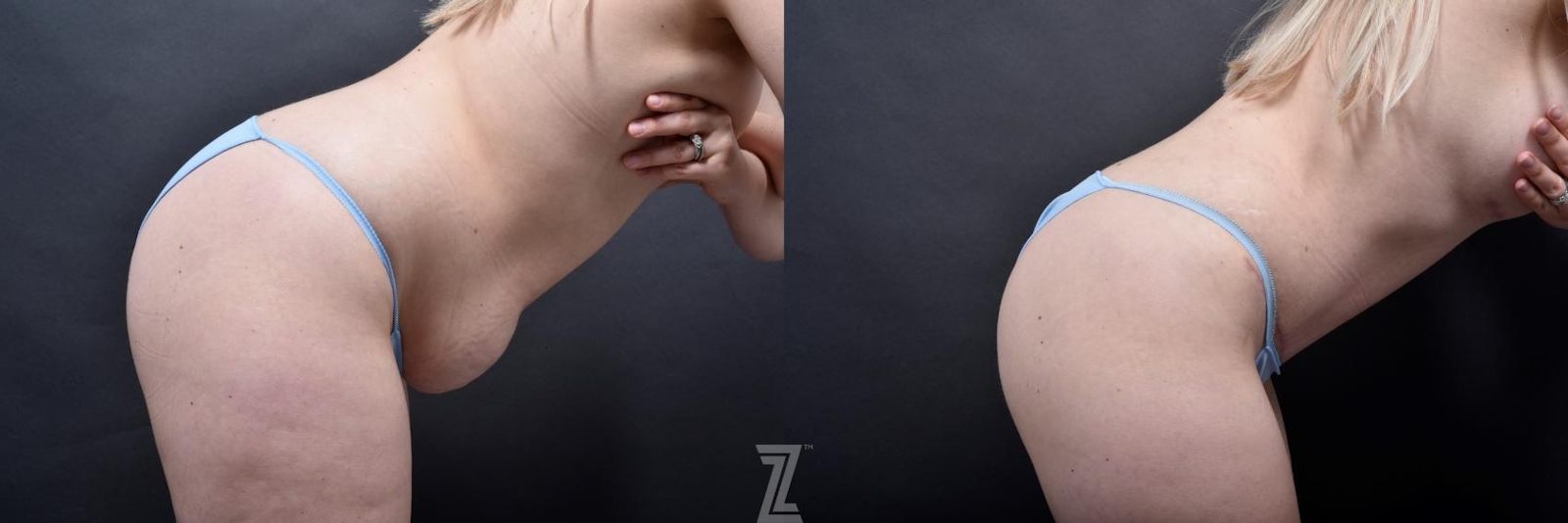 Austin Lateral View of Abdomen in Flexion of 29-Year-Old - Mommy Makeover Before & After by Dr. Rocco Piazza in Austin, Texas - The Piazza Center