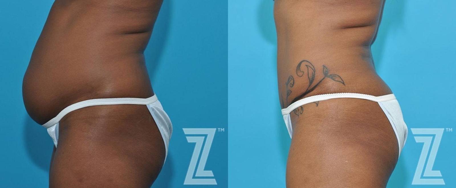 Austin Lateral Abdomen view of 43-year-old mother of two mommy maker over - Dr. Rocco Piazza - The Piazza Center
