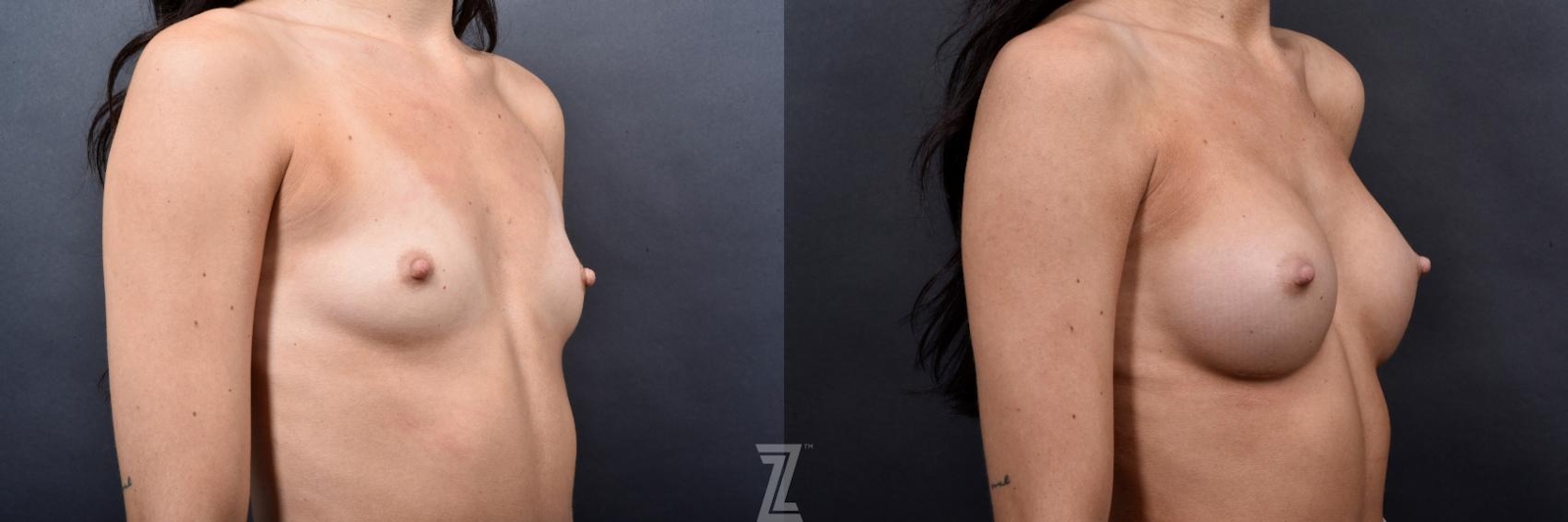 Austin Oblique view of 24 year old woman 6 month post op with Silicone Implants with Cohesive Silicone Gel - Dr. Rocco Piazza - The Piazza Center