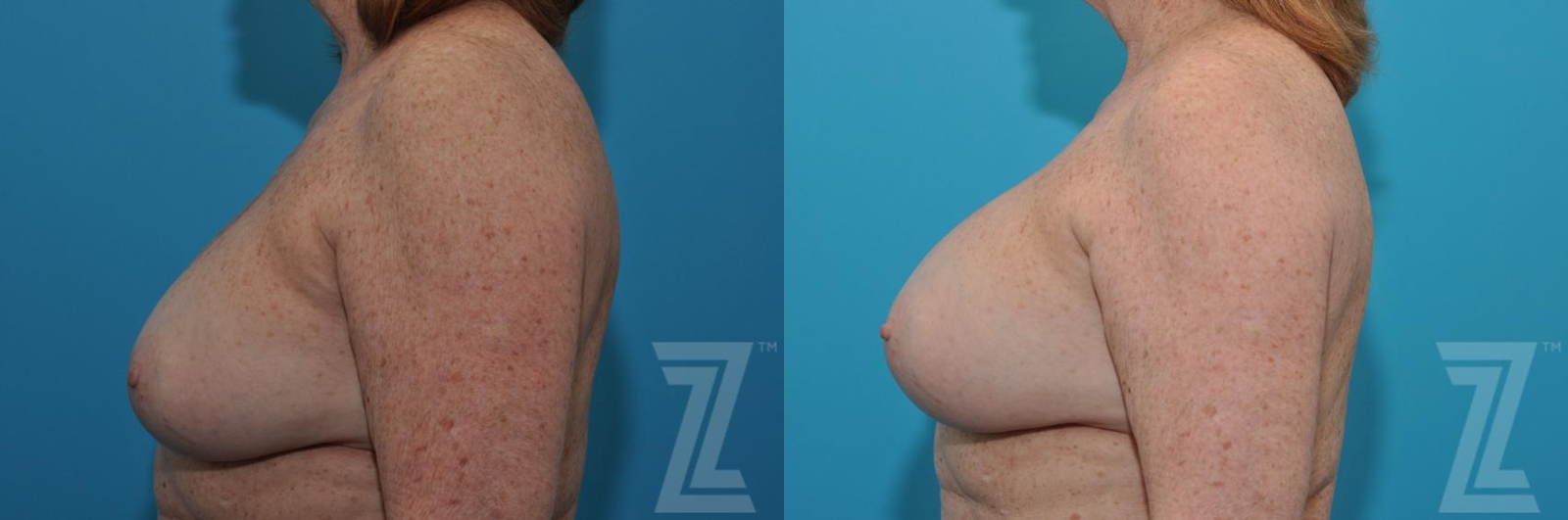 Austin Breast Augmentation Revision Before & After Gallery - Patient 132886549 - Image 3 - The Piazza Center