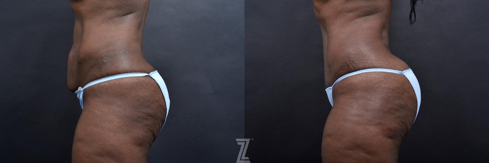 Austin Lateral Abdomen View 1 Year Post-OP Mommy Makeover in Austin, TX by Dr. Rocco Piazza - The Piazza Center