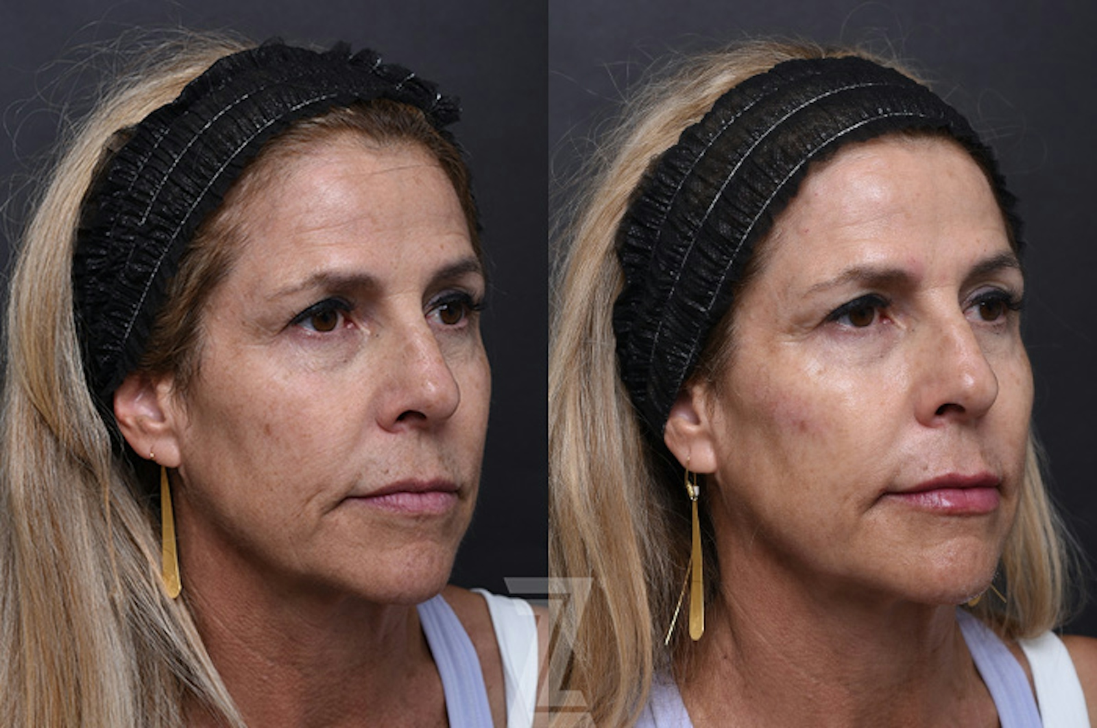 Austin Injectable Fillers Before & After Gallery - Patient 901099 - Image 1 - The Piazza Center