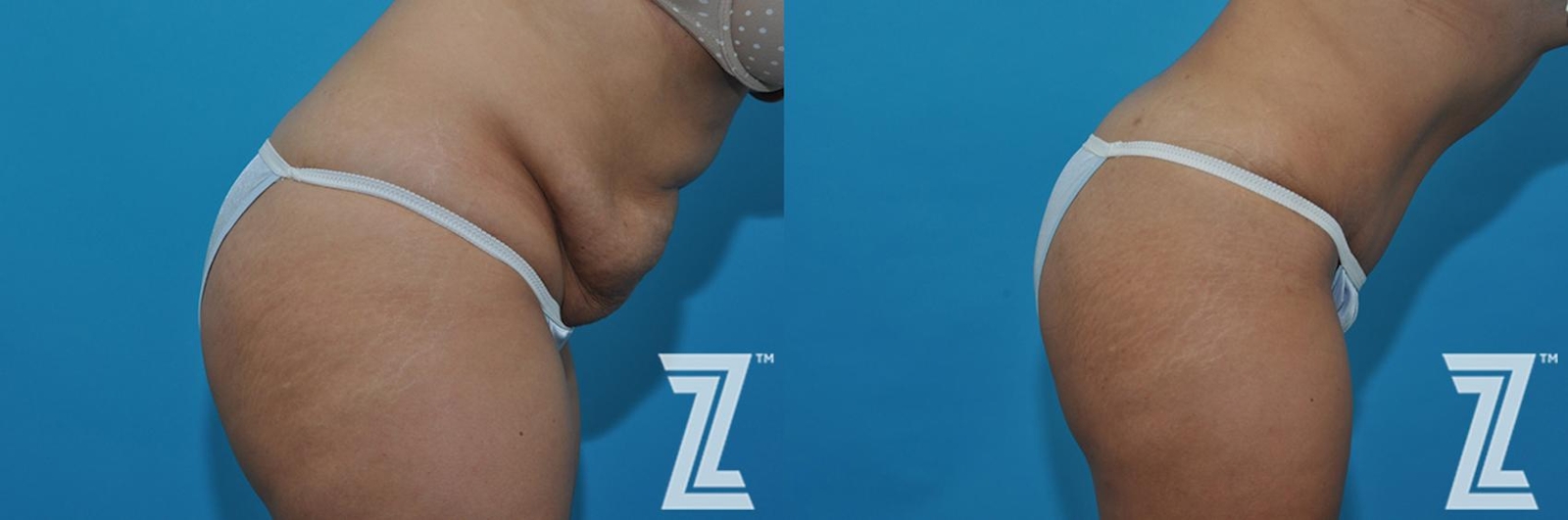 Austin Tummy Tuck Before & After Gallery - Patient 132886863 - Image 6 - The Piazza Center