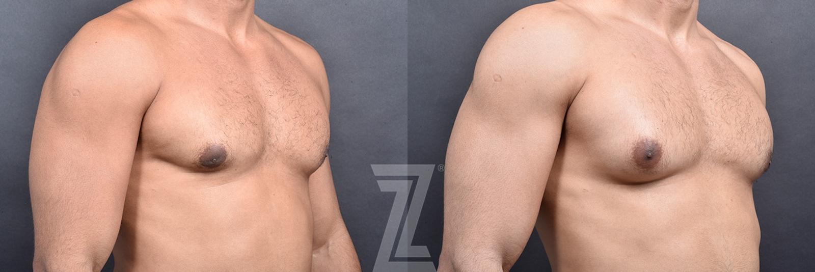 Austin Gynecomastia/Male Breast Reduction Before & After Gallery - Patient 377773 - Image 1 - The Piazza Center
