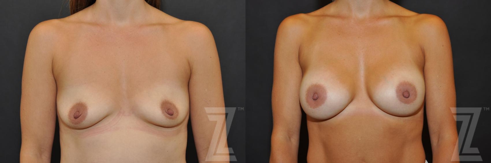 Austin front view before and after image of 36-year-old mother of four breast augmentation at the piazza center - The Piazza Center
