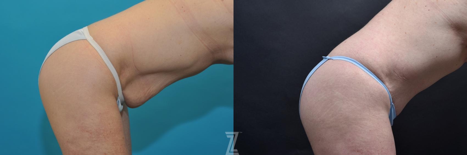 Austin Oblique flexion view 7 year post op mommy makeover - The Piazza Center, Austin Tx - The Piazza Center