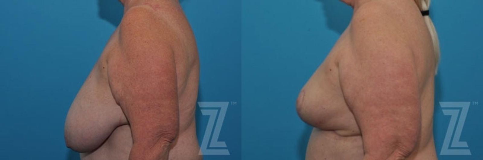 Austin Breast Reduction Before & After Gallery - Patient 132886611 - Image 3 - The Piazza Center