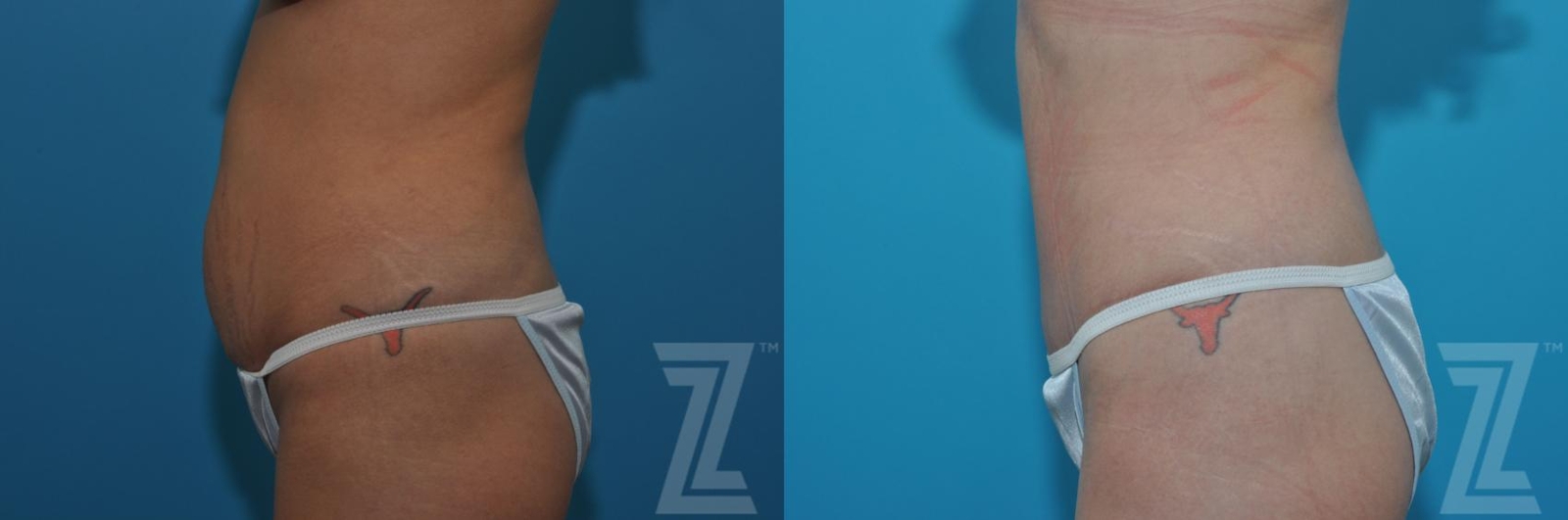 Austin Tummy Tuck Before & After Gallery - Patient 132886879 - Image 2 - The Piazza Center