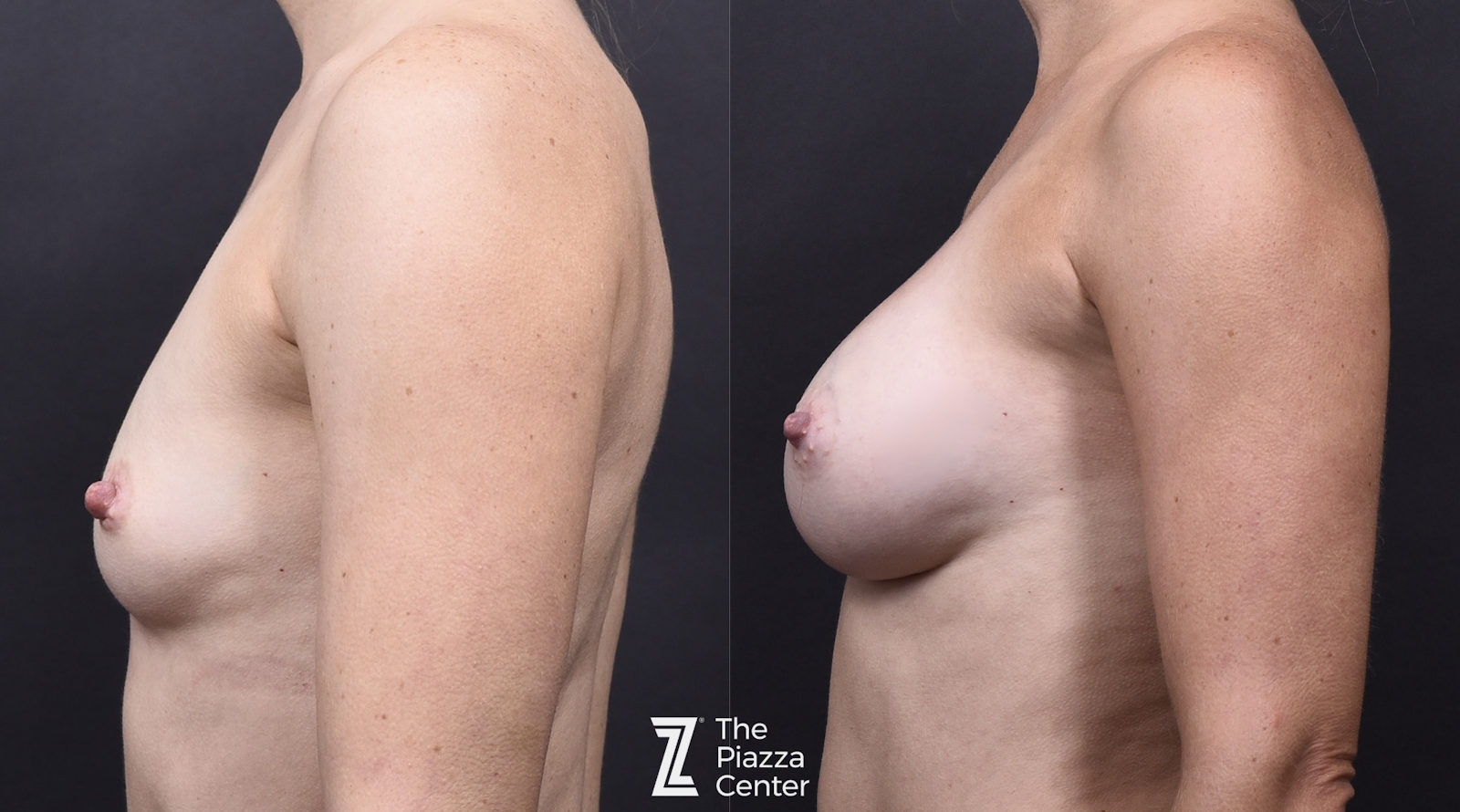 Austin Breast Augmentation Before & After Gallery - Patient 141191 - Image 5 - The Piazza Center
