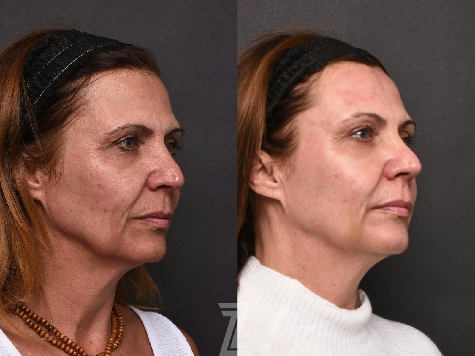 Austin HALO Before & After Gallery - Patient 132963260 - Image 2 - The Piazza Center