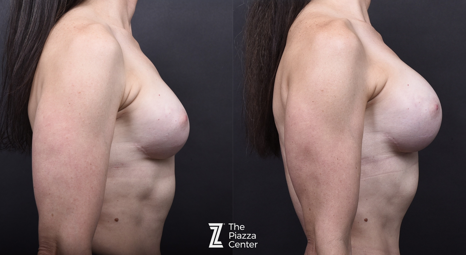 Austin Breast Augmentation Before & After Gallery - Patient 276383 - Image 4 - The Piazza Center