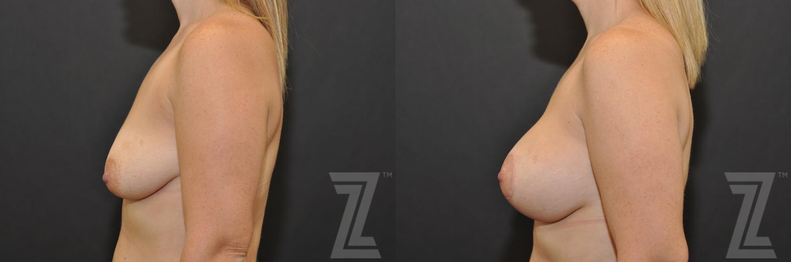 Austin Breast Augmentation With a Breast Lift Before & After Gallery - Patient 132791094 - Image 3 - The Piazza Center