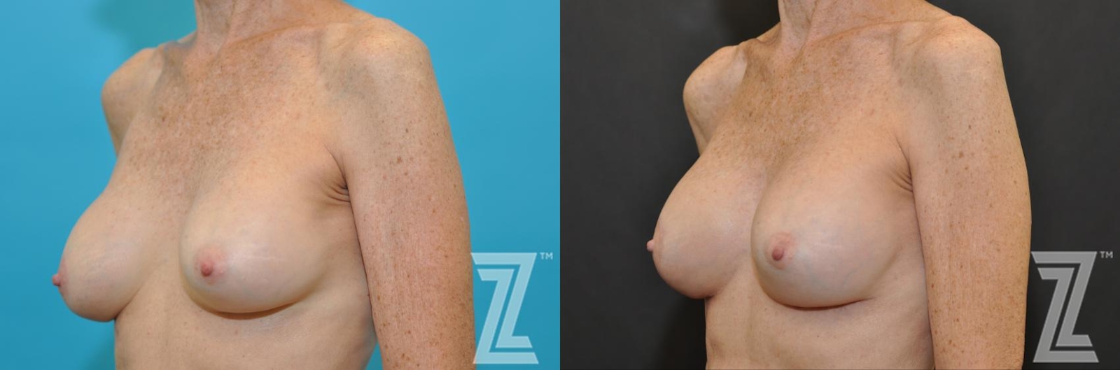 Austin Breast Augmentation Revision Before & After Gallery - Patient 132793347 - Image 2 - The Piazza Center