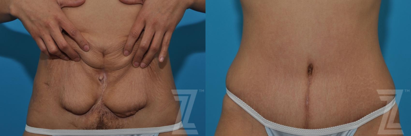 Austin Tummy Tuck Before & After Gallery - Patient 132886797 - Image 6 - The Piazza Center