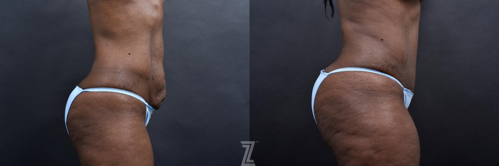 Austin 1 Year Post-OP Mommy Makeover in Austin, TX by Dr. Rocco Piazza - Lateral Abdomen View - The Piazza Center