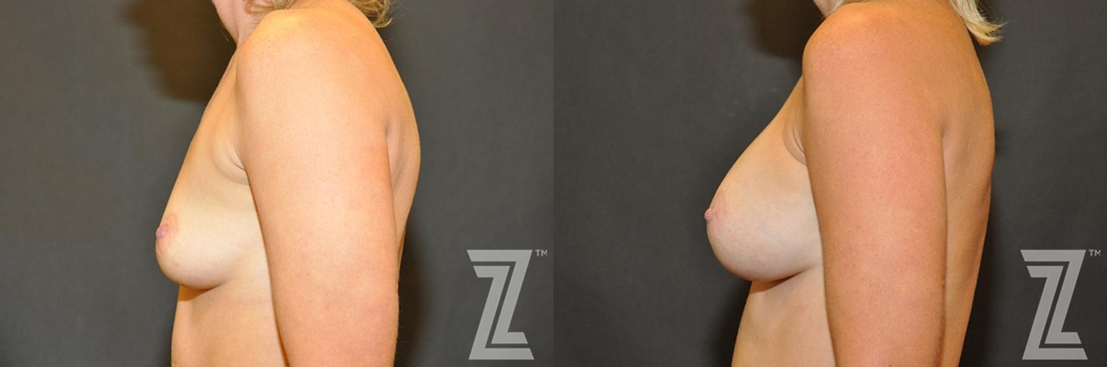 Austin Lateral view before & after images of 35-year-old mother of two 8 month post op breast augmentation - Dr. Rocco Piazza - The Piazza Center