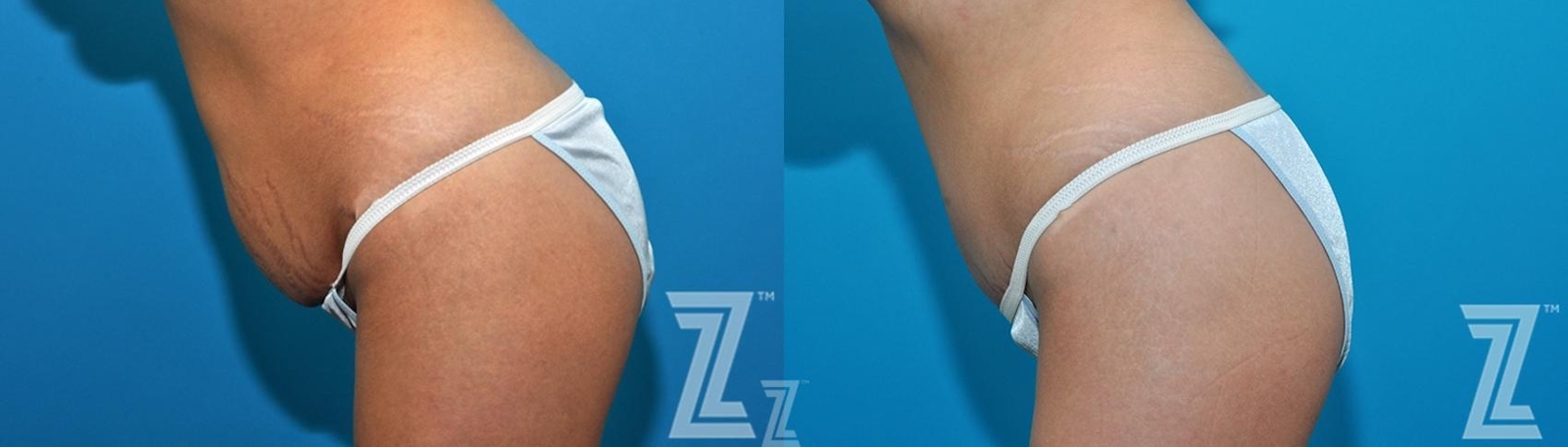 Austin 36 year old woman 1 year post op oblique flexion view mommy makeover - Austin Tx, The Piazza Center - The Piazza Center