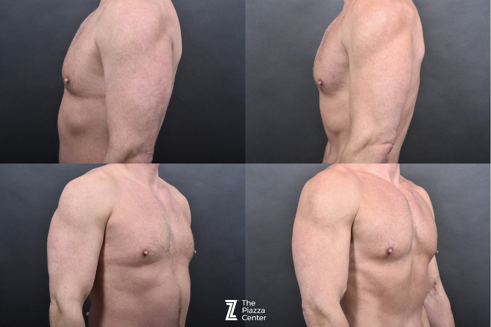 Austin Male Body Contouring Before & After Gallery - Patient 219361 - Image 6 - The Piazza Center