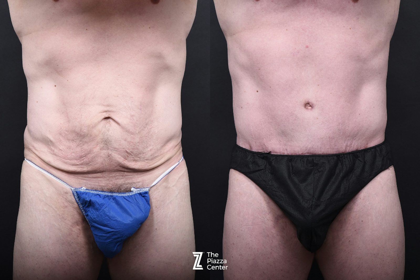 Austin Tummy Tuck Before & After Gallery - Patient 830228 - Image 1 - The Piazza Center