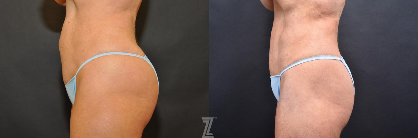 Austin Skin Pinch Before & After Gallery - Patient 132886906 - Image 2 - The Piazza Center