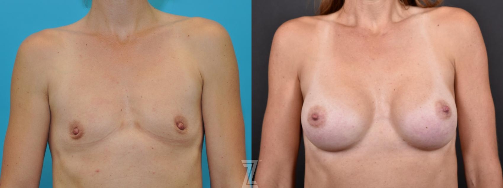 Austin Before and After 5 year post op of Silicone Implants with Highly Cohesive Gel (Gummy Bear Implants) - The Piazza Center