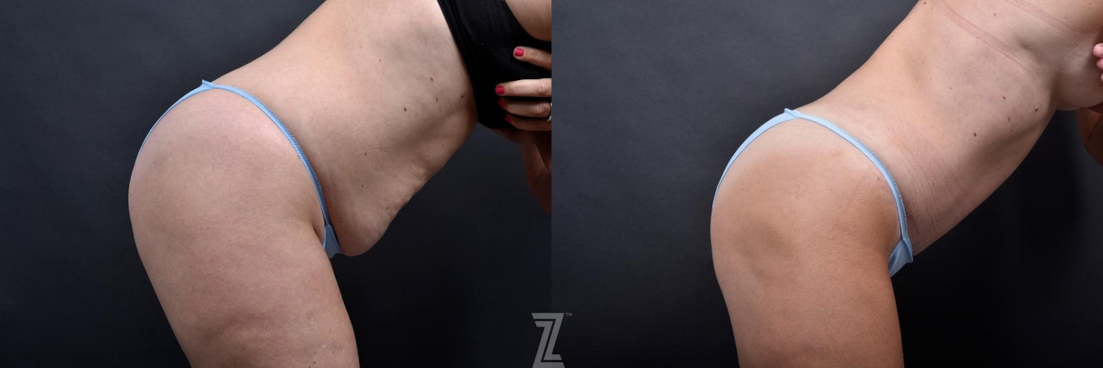 Austin Tummy Tuck Before & After Gallery - Patient 132886865 - Image 5 - The Piazza Center